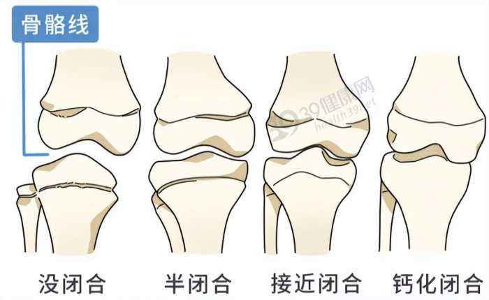 2014年，20岁北京男孩李亚诺，花16万断骨增高7.2厘米，后来如何