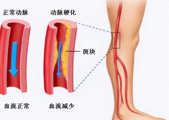 睡觉时腿频发抽筋，是缺钙？错！还有3个原因，千万别忽视了